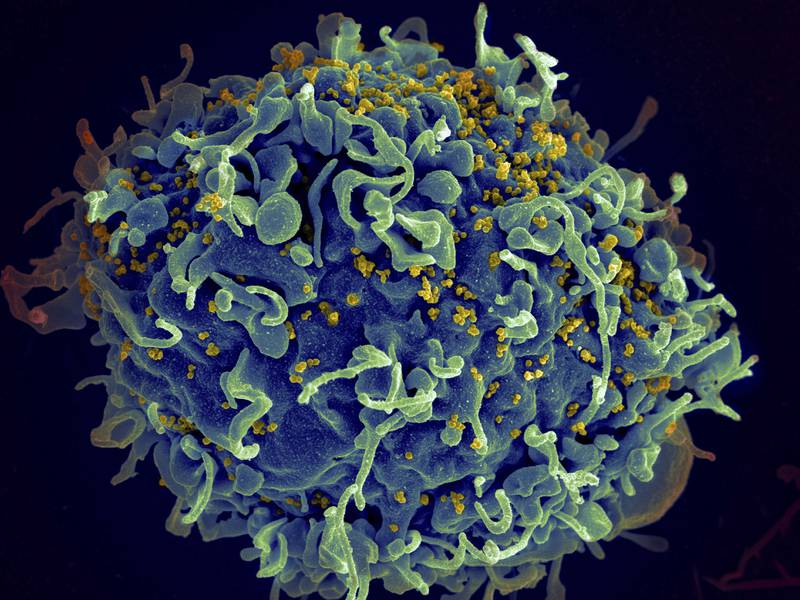 FILE - This colorized electron microscope image provided by the U.S. National Institutes of Health shows a human T cell, in blue, under attack by HIV, in yellow, the virus that causes AIDS. (Seth Pincus, Elizabeth Fischer, Austin Athman/National Institute of Allergy and Infectious Diseases/NIH via AP, File)