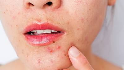 Myths and facts about acne