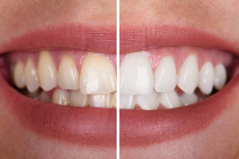 Metro Square Dental - Brighten Your Smile with Professional In-Office Teeth Whitening