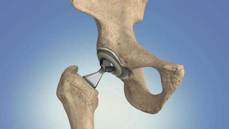 Although osteoarthritis can damage any joint, the disorder most commonly affects your hands, knees, hips and spine.