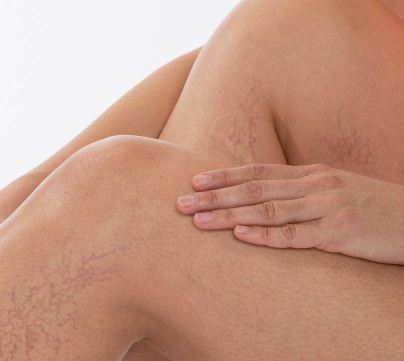 Fox Valley Vein Centers - 3 Things to Know About Varicose Veins