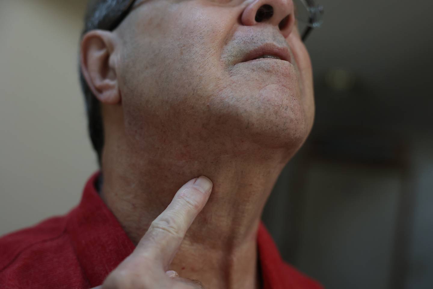 Edward Meyer points to the spot where an incision was made to attach the Inspire device leads to a nerve on the tongue to help with sleep apnea. Edward was the first to have the procedure done at Silver Cross Hospital. Wednesday, June 28, 2022 in New Lenox.