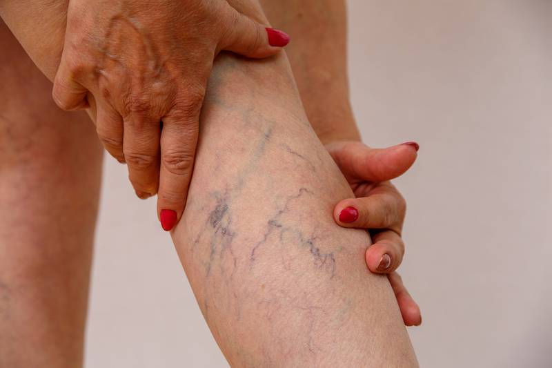 Eterna MedSpa & Laser Vein Center - The Importance of Vein Health