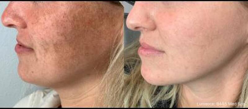 Eterna MedSpa & Laser Vein Center - Lumecca: Illuminate Your Skin And Save 20% At Eterna MedSpa This November