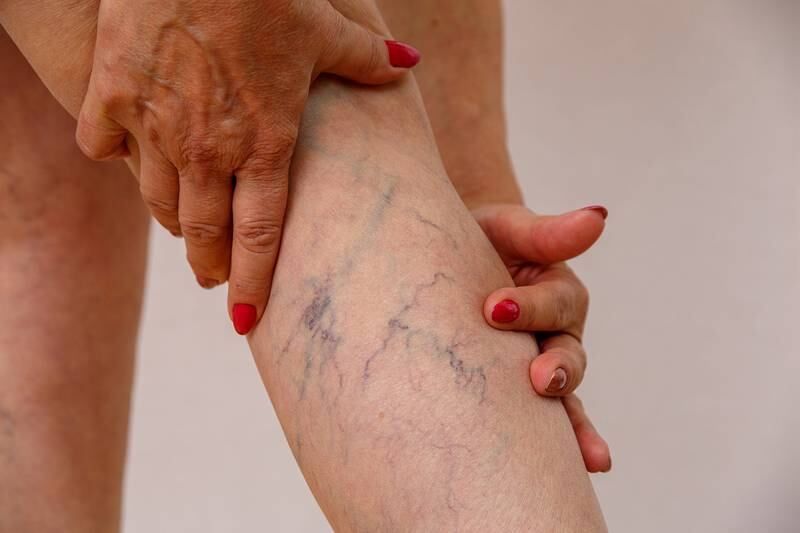Eterna MedSpa & Laser Vein Center - Three things to know about varicose veins