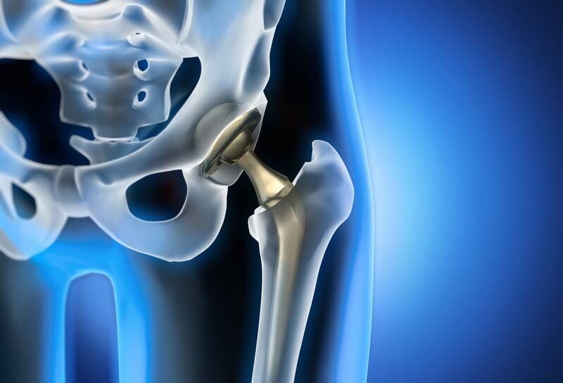 Meyers, Flowers, Bruno, McPhederan and Herrmann - Defective Hip Implants