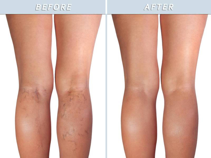 Eterna MedSpa & Laser Vein Center - Get rid of varicose veins safely and effectively with laser treatments