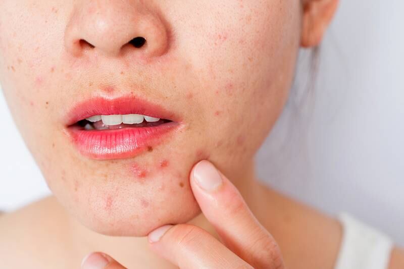 Eterna MedSpa & Laser Vein Center - Should I pop my pimples?