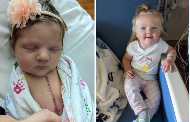 Hannah Willingham if McHenry turns one year old on June 2, 2023, and is set for a life-saving open heart surgery on June 7 at Stanford University's Lucile Packard Children's Hospital. Her first open heart surgery was at just two weeks old.