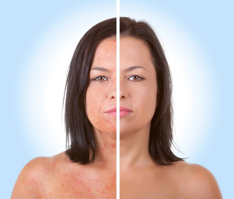 Eterna MedSpa & Laser Vein Center - Rejuvenate Your Skin This Fall With Microneedling at Eterna MedSpa