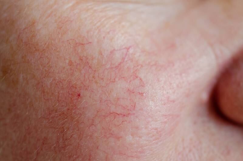 Eterna MedSpa & Laser Vein Center - What causes facial spider veins?