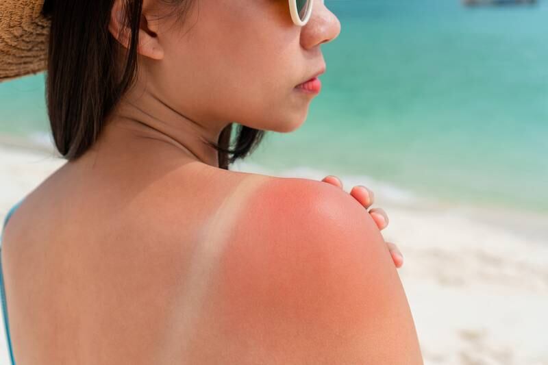 Merry Maids of Sycamore  - Holistic Remedies to Treat Sunburns at Home