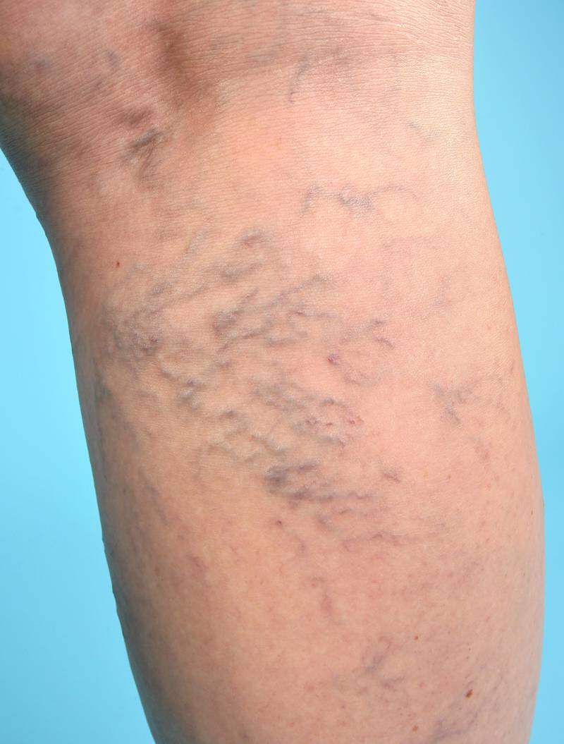 Eterna MedSpa & Laser Vein Center - What’s the difference between varicose veins and spider veins?