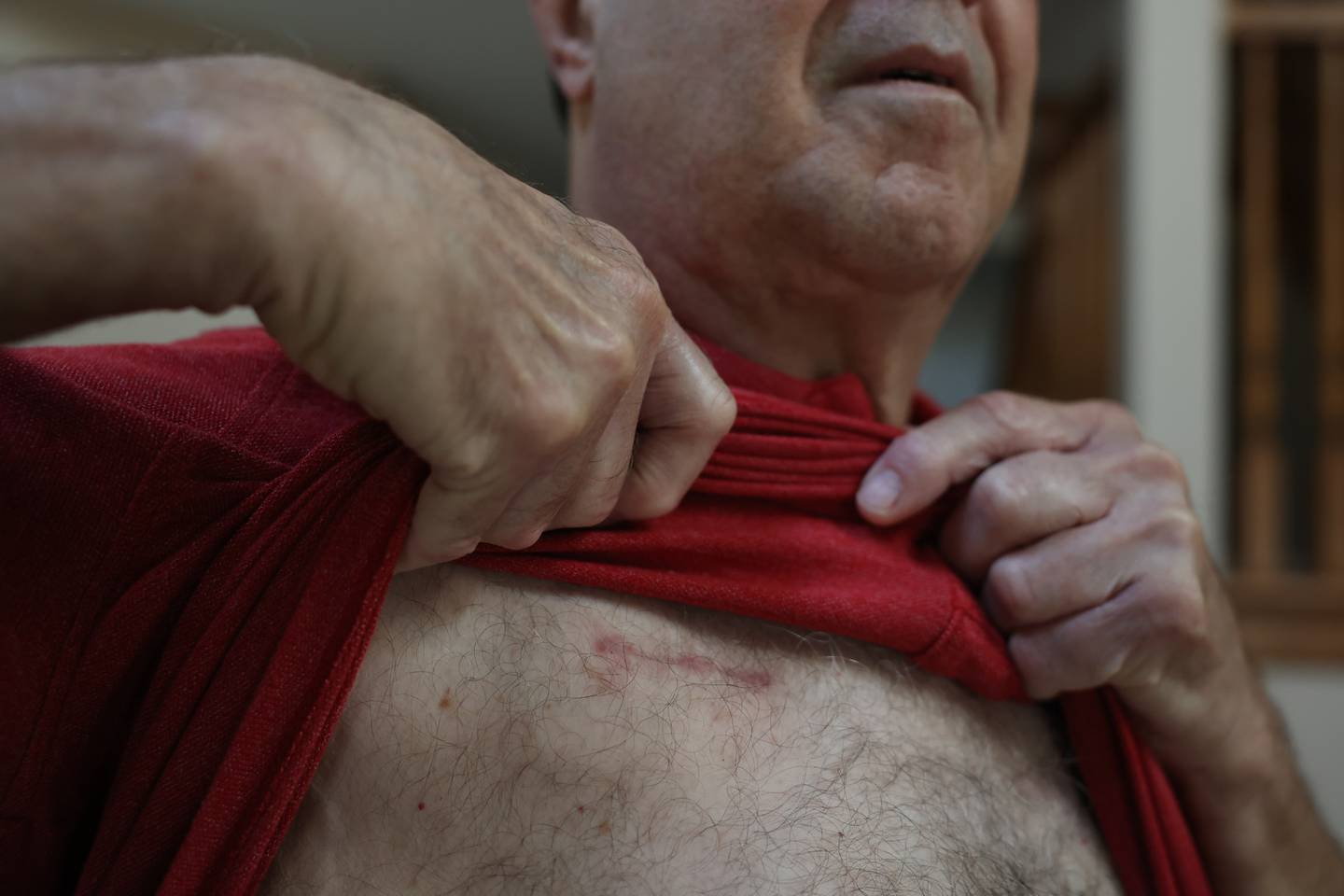 A scar is still visible where the Inspire device was inserted to help with Edward Meyer’s sleep apnea. Edward was the first to have the procedure done at Silver Cross Hospital. Wednesday, June 28, 2022 in New Lenox.