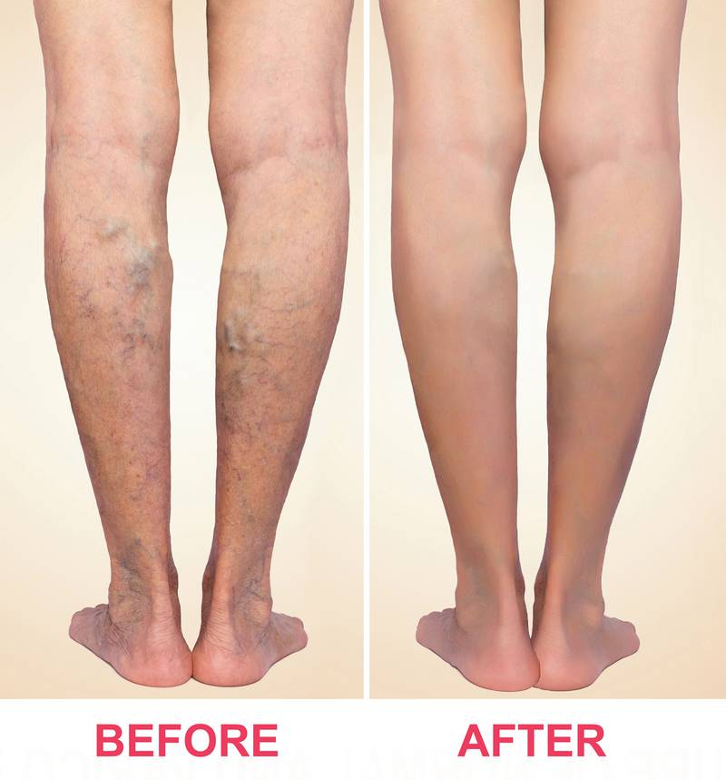 Eterna MedSpa & Laser Vein Center - Beyond Summer: Why Vein Disease Needs Attention All Year Round